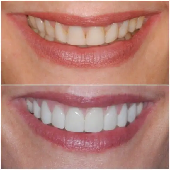 Porcelain-smile-before-and-after-580×580