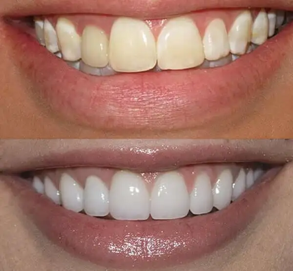 Veneers-before-and-after-_2