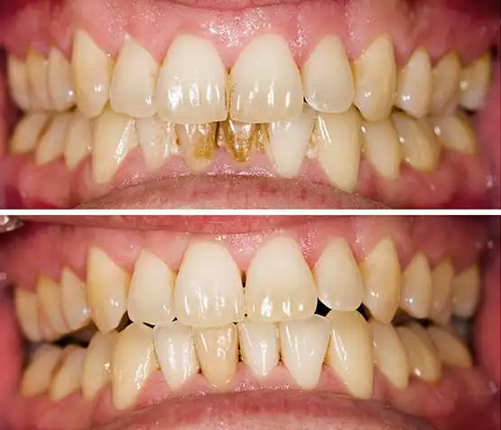 plaque-removal-before-after