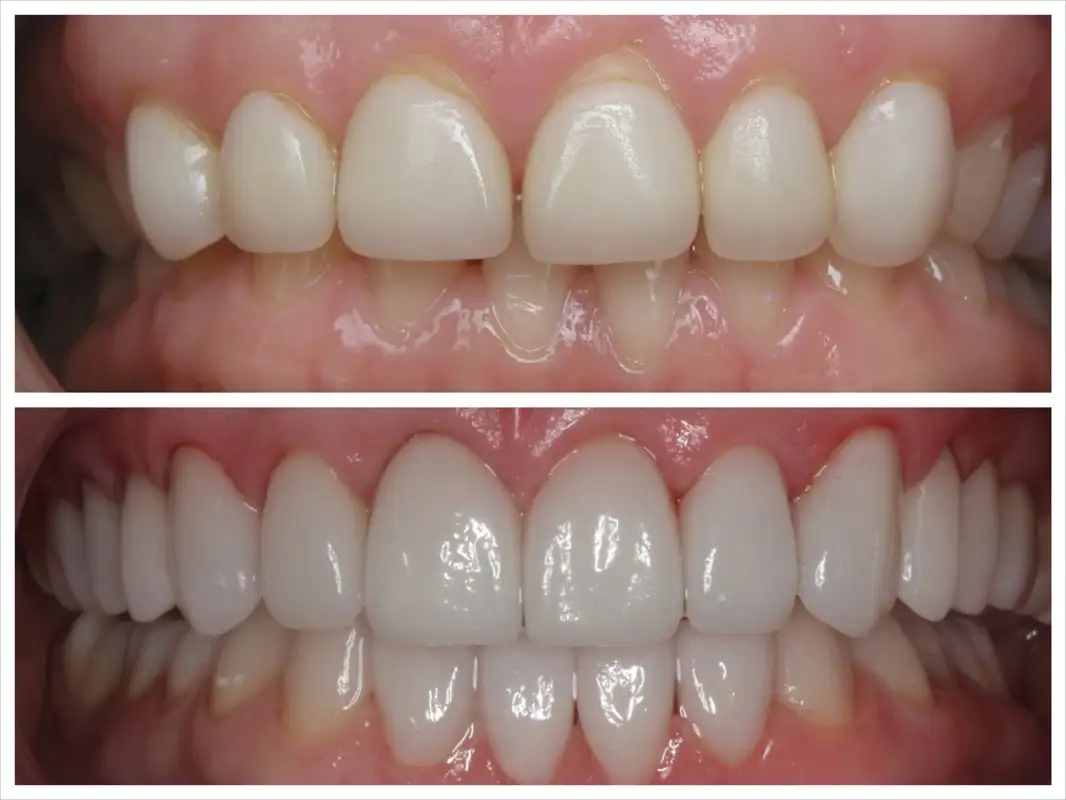 porcelain_veneers_before_after