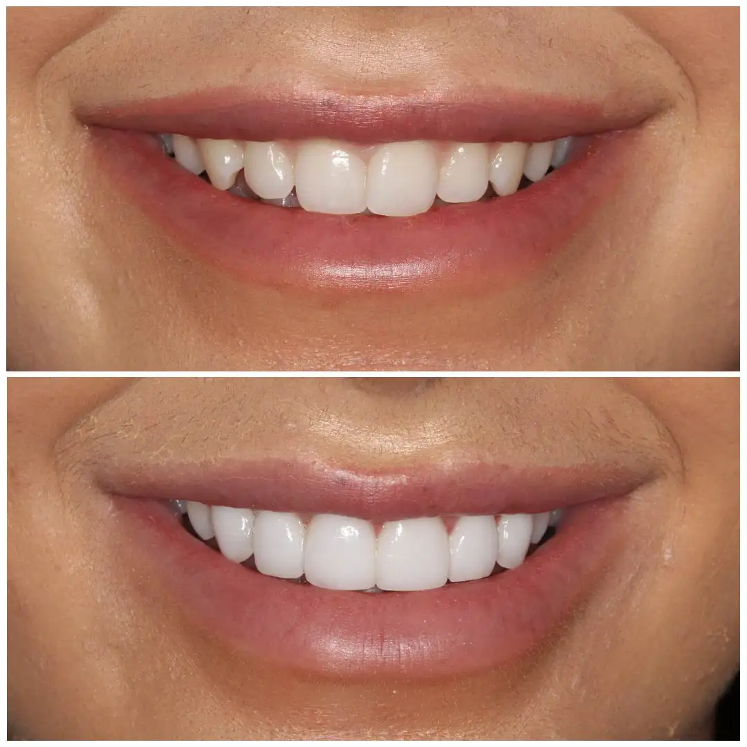 smiling-dental-porcelain-veneers-before-after-15