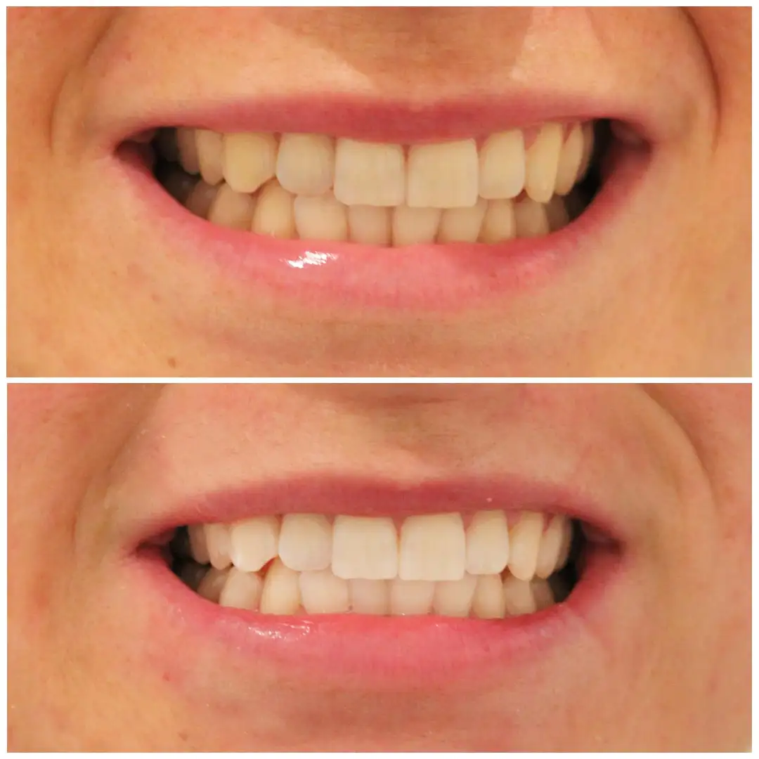 smiling-dental-teeth-whitening-before-after-5