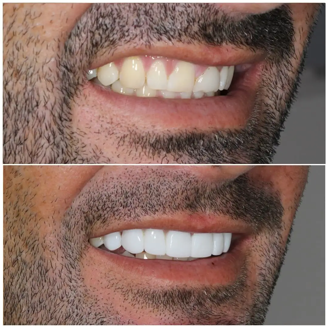 smiling-dental-tooth-bonding-before-after-1422-compress