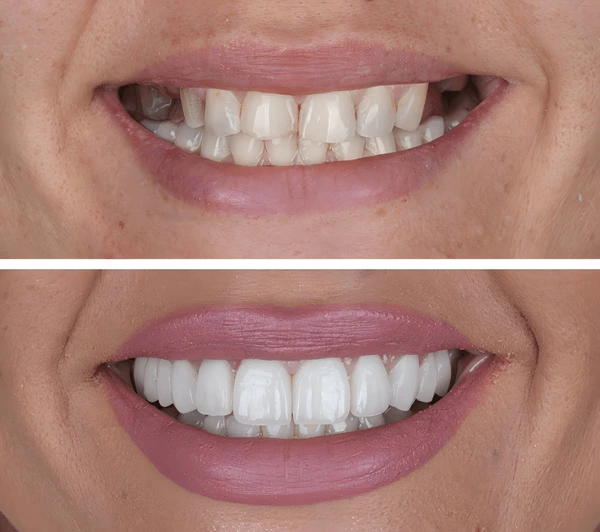 Teeth Treatment
